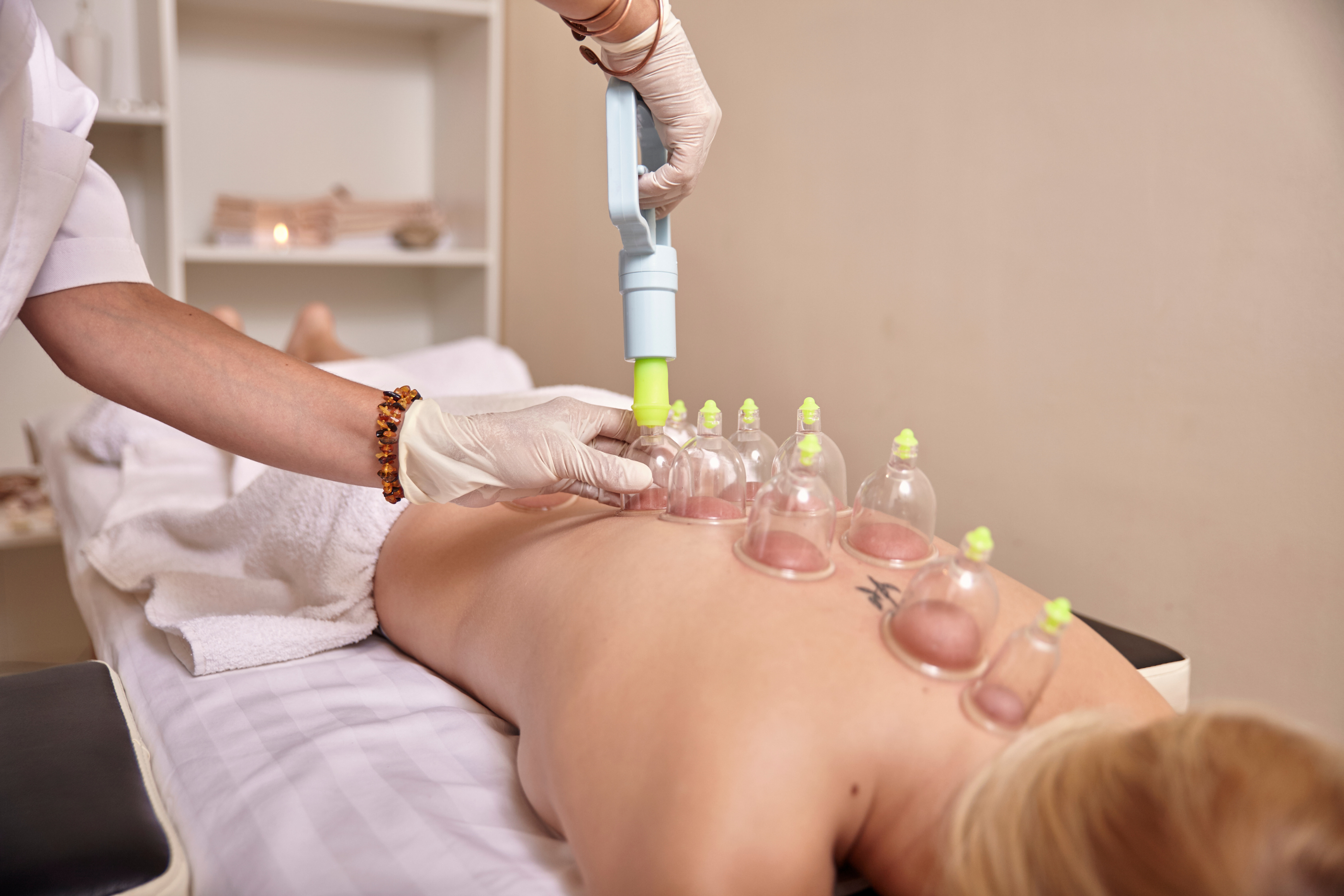 Cupping / Hijama Therapy - Image 4